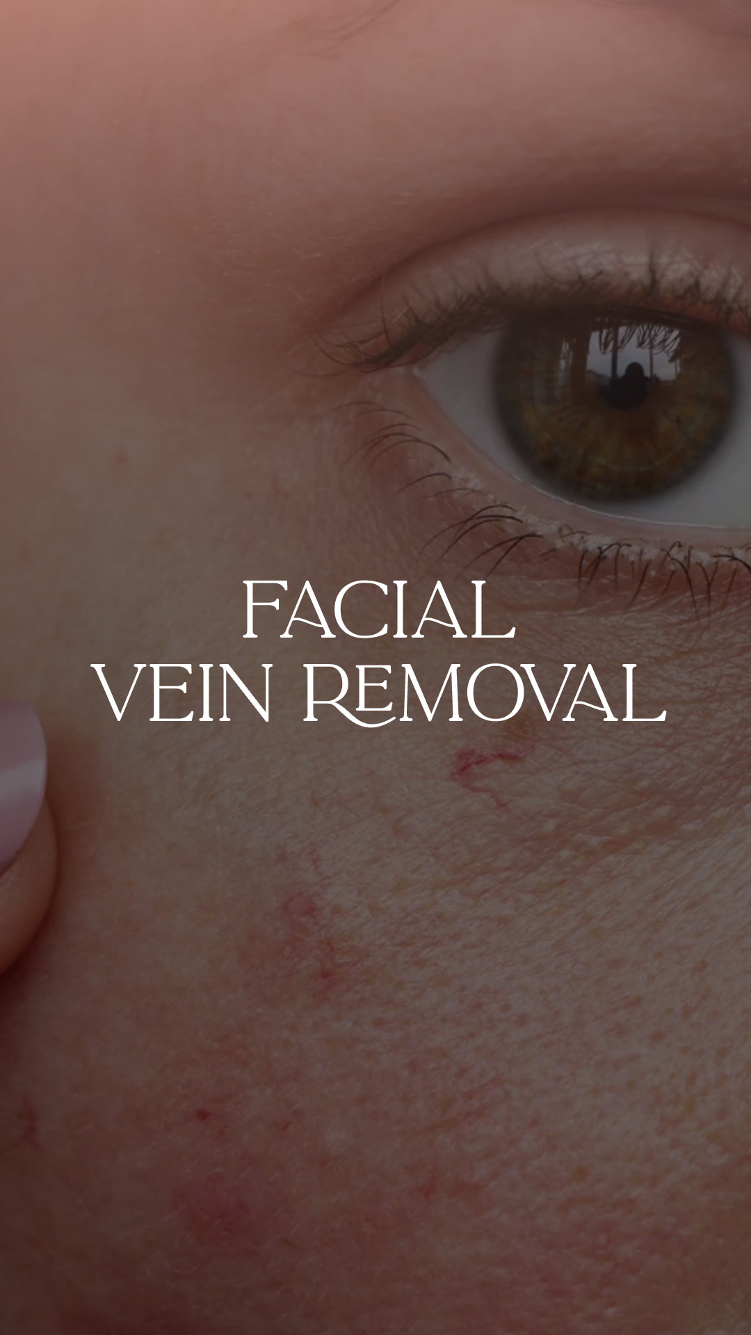 facial vein removal