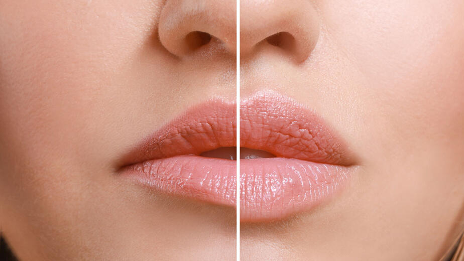 Natural Results with Fillers