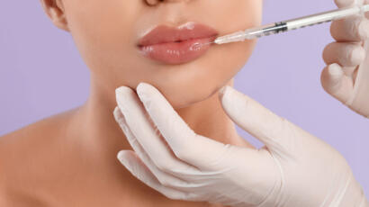 Lip Fillers
