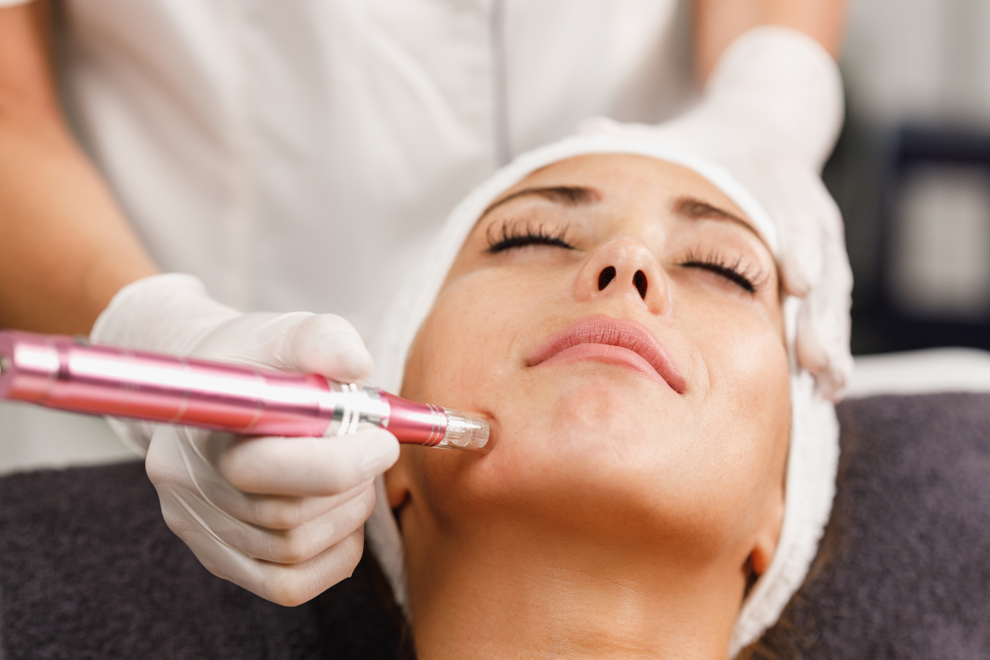 Microneedling in Manotick How It Works, Benefits, and Why It’s One of 2026’s Most Popular Skin Treatments